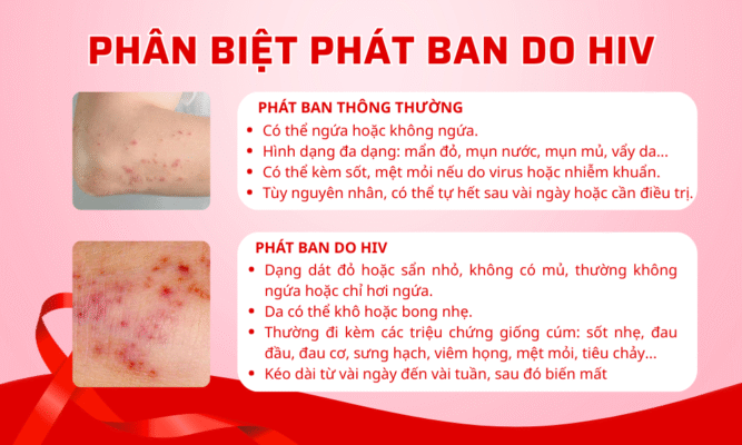 Phân biệt phát ban do HIV